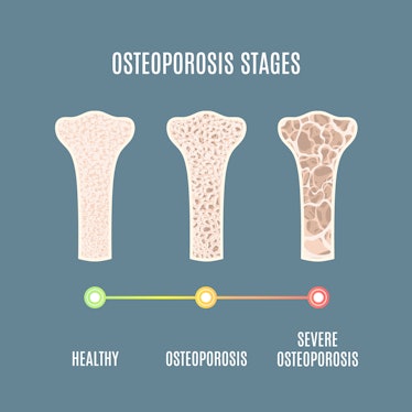 Osteoporosis process infographic of bone tissue close-up with different density. Skeletal system dis...