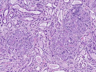 Amyloid deposits in the glomeruli of kidney (amyloidosis)