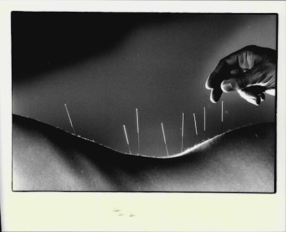 Acupuncture procedure, four editors try, black and white