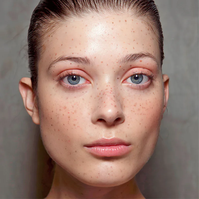 What The Dark Spots On Your Skin Really Mean